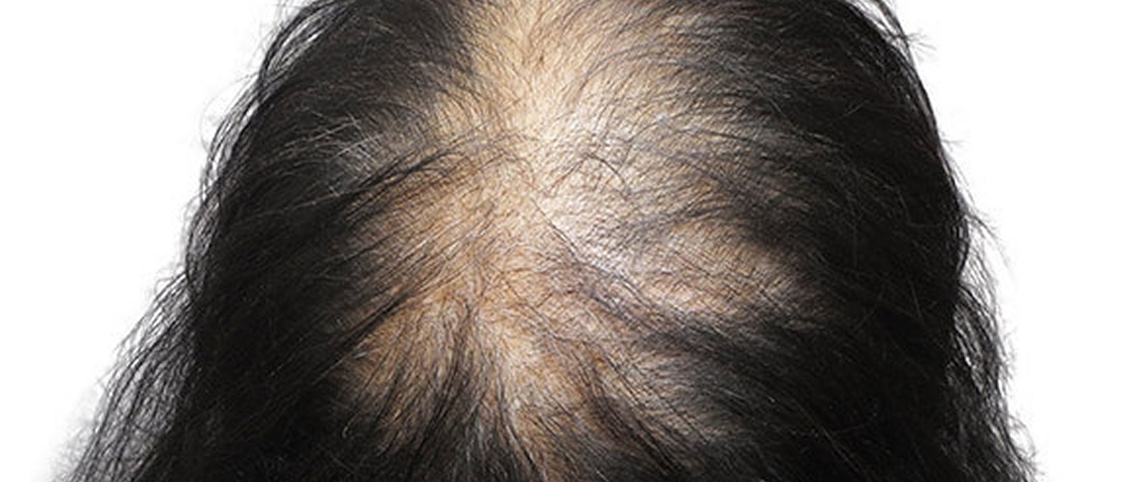 Most kinds of hair loss can be reversed naturally